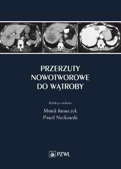Przerzuty nowotworowe do wątroby - Marek Krawczyk